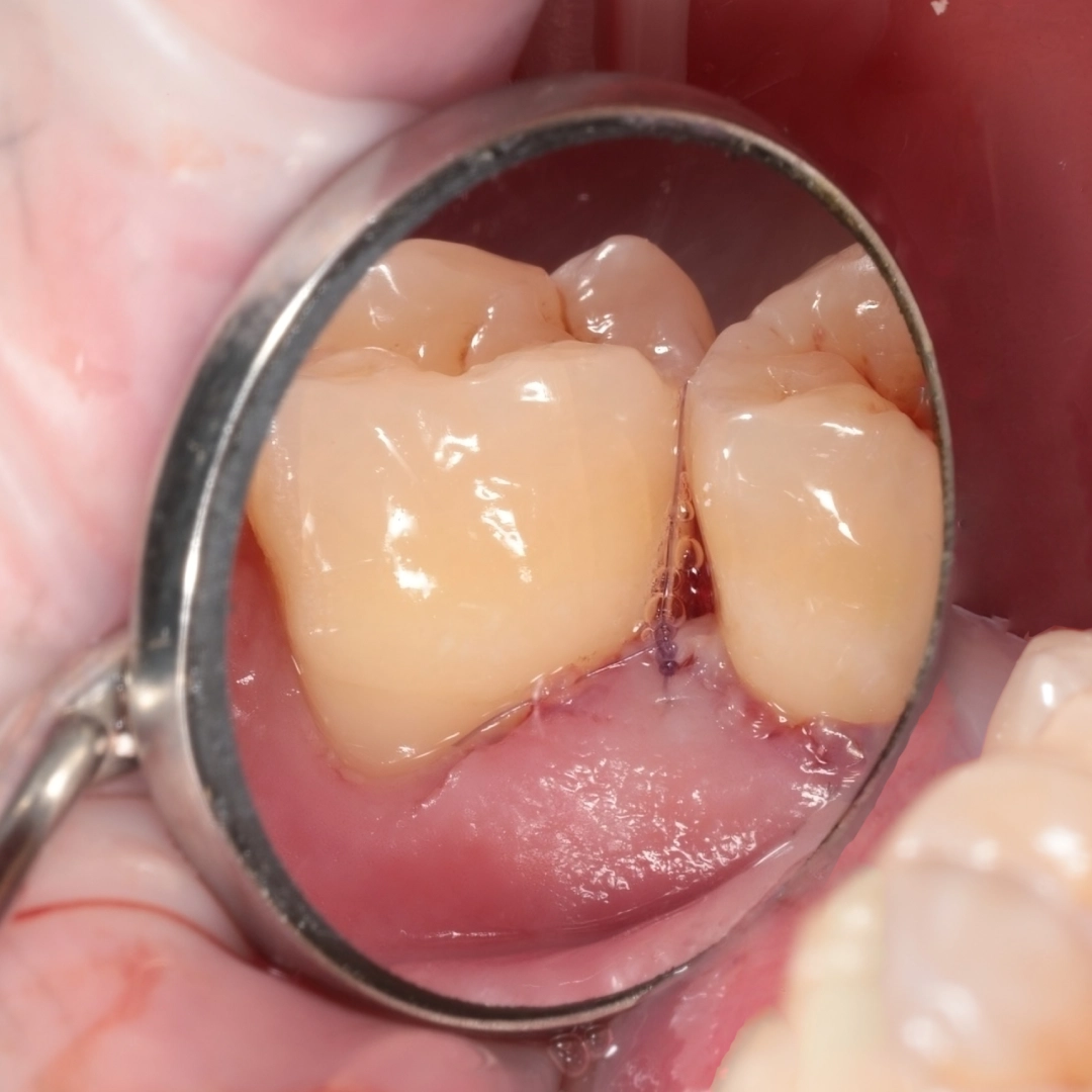Chirurgie esthétique parodontale